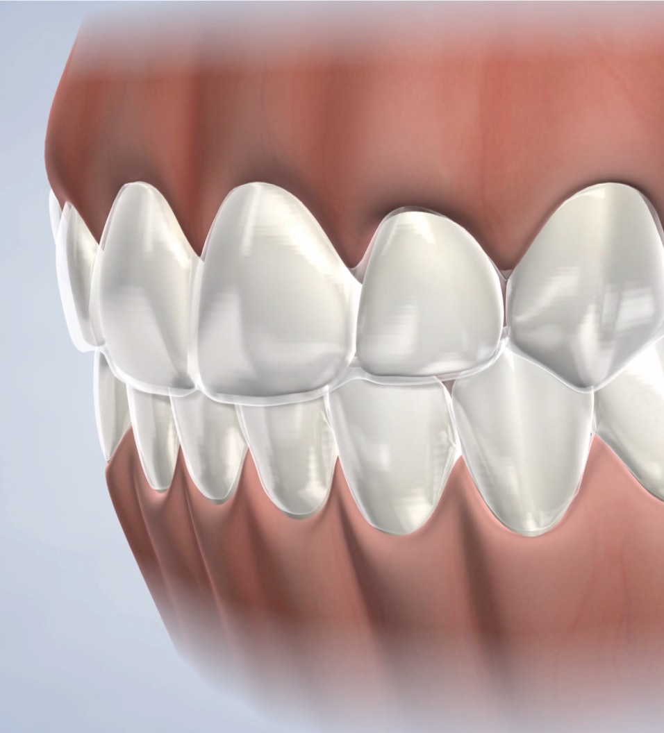 Invisalign procedure procedure query page