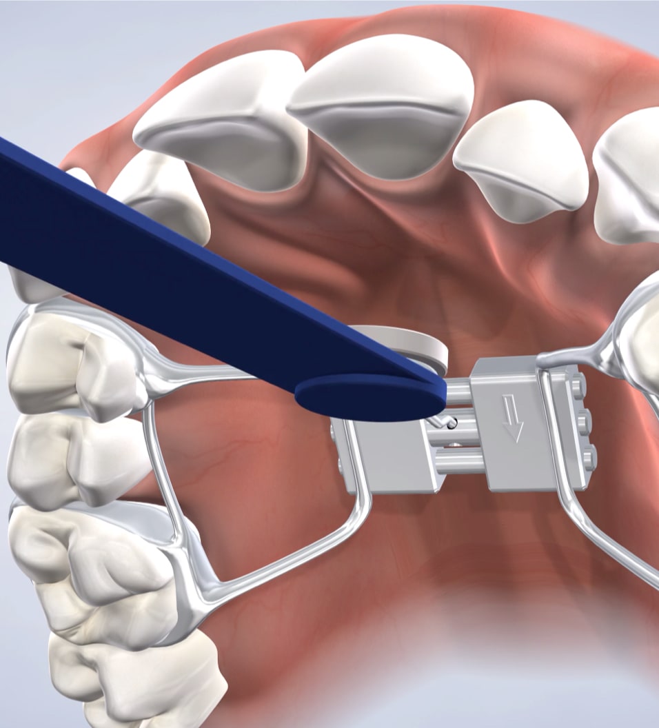 Palatal expansion procedure query page