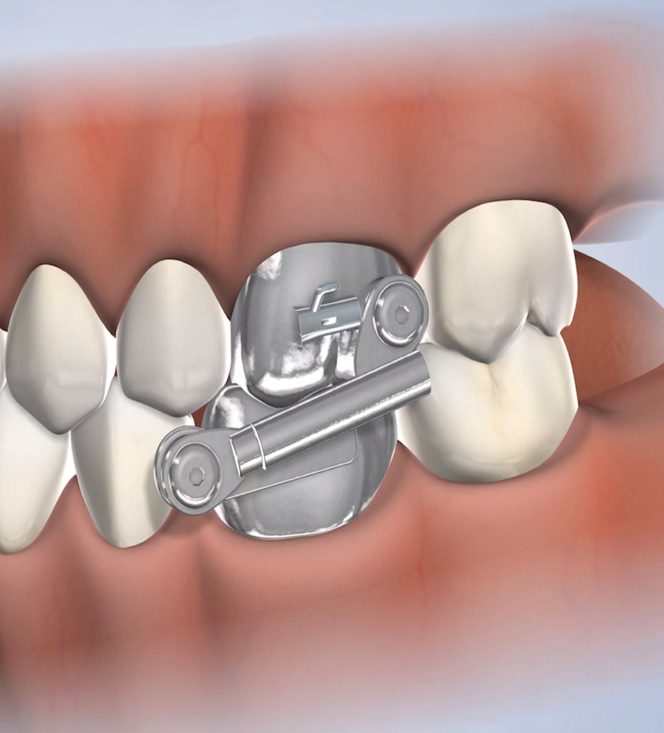 Procedure herbst appliance query