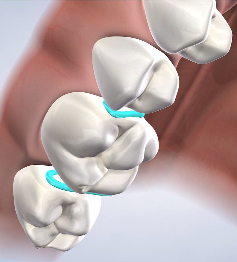 Separators procedure query page