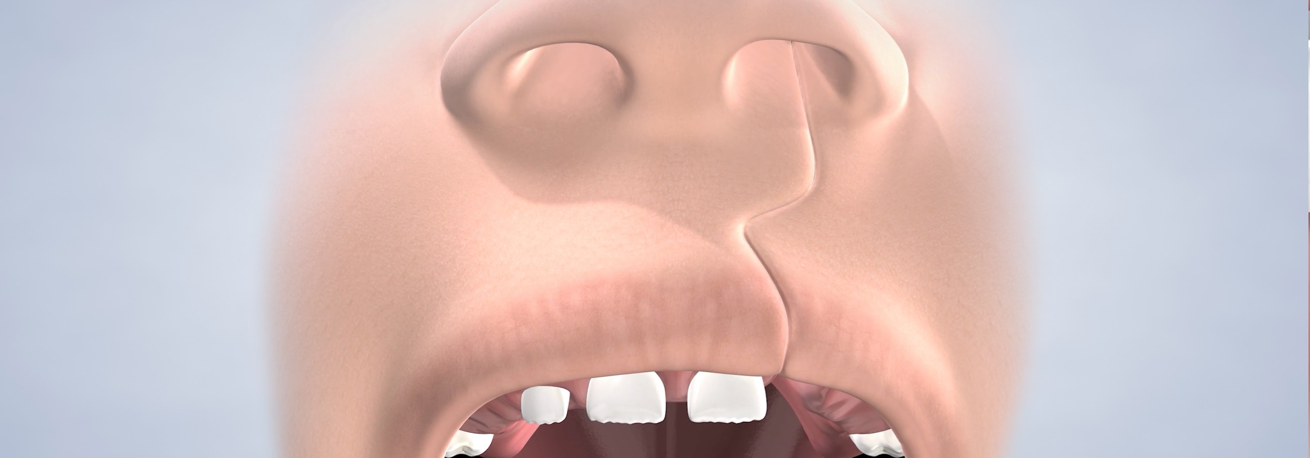 Procedure hero desktop cleft lip and cleft palate