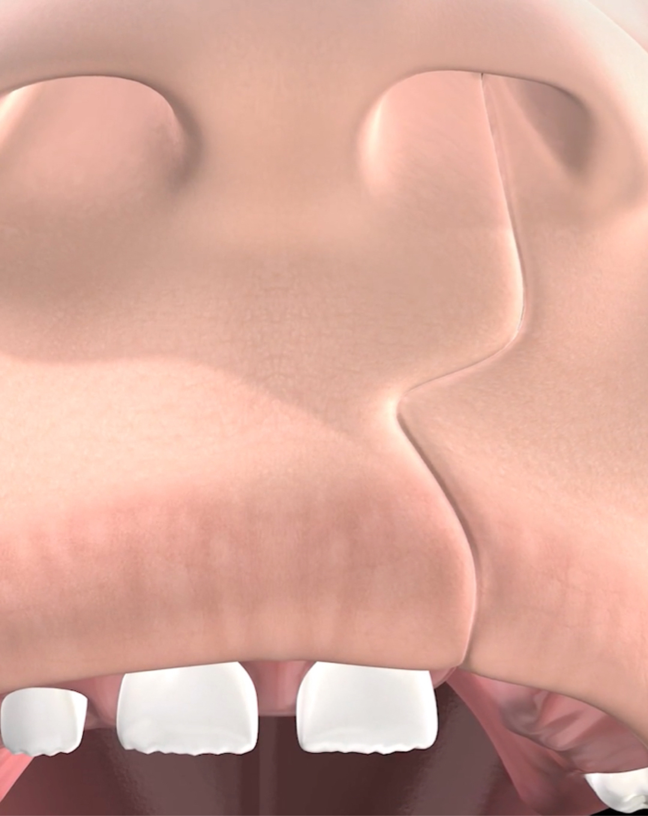 Procedure hero mobile cleft lip and cleft palate