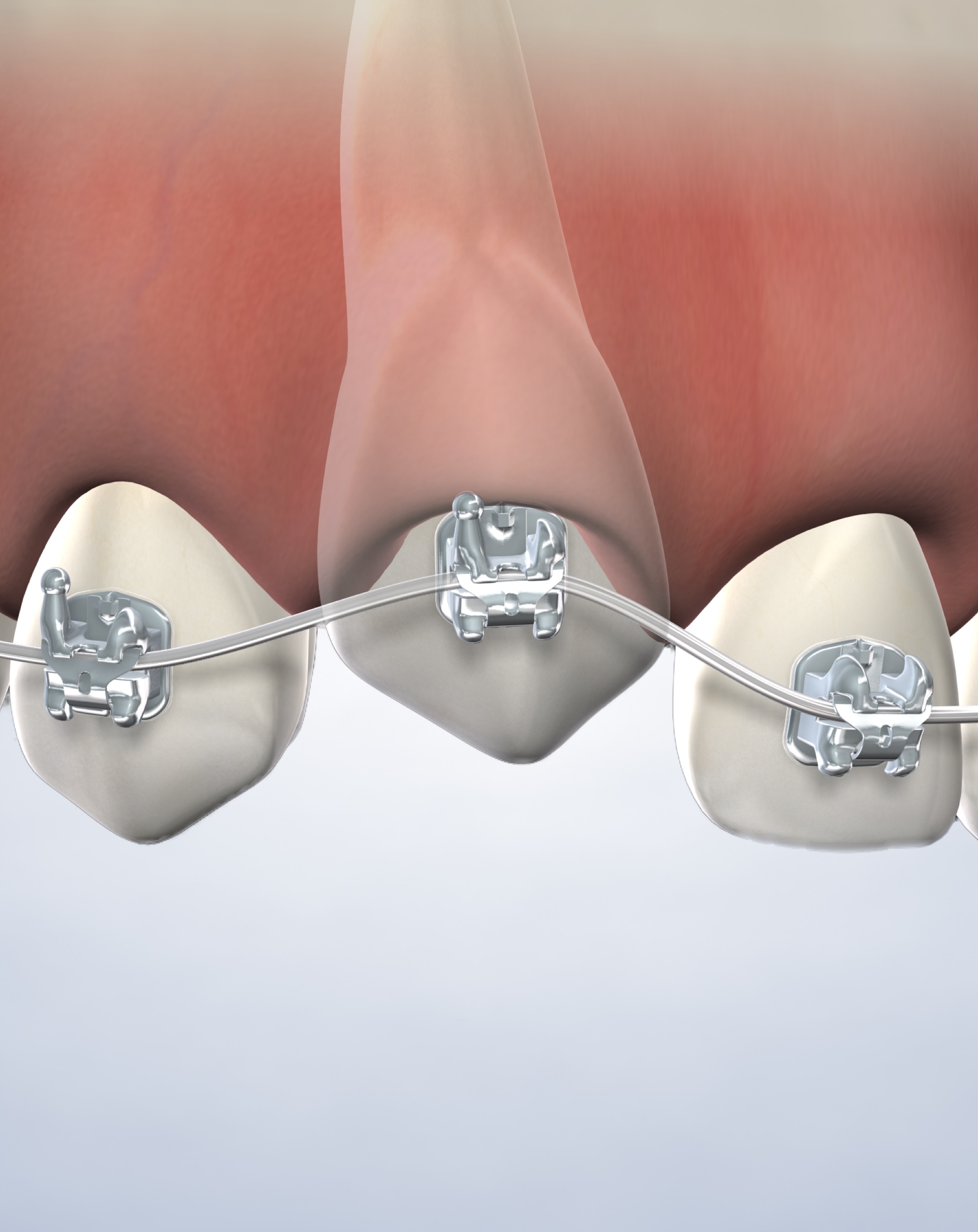 Impacted tooth exposure in Reno and Sparks, Nevada