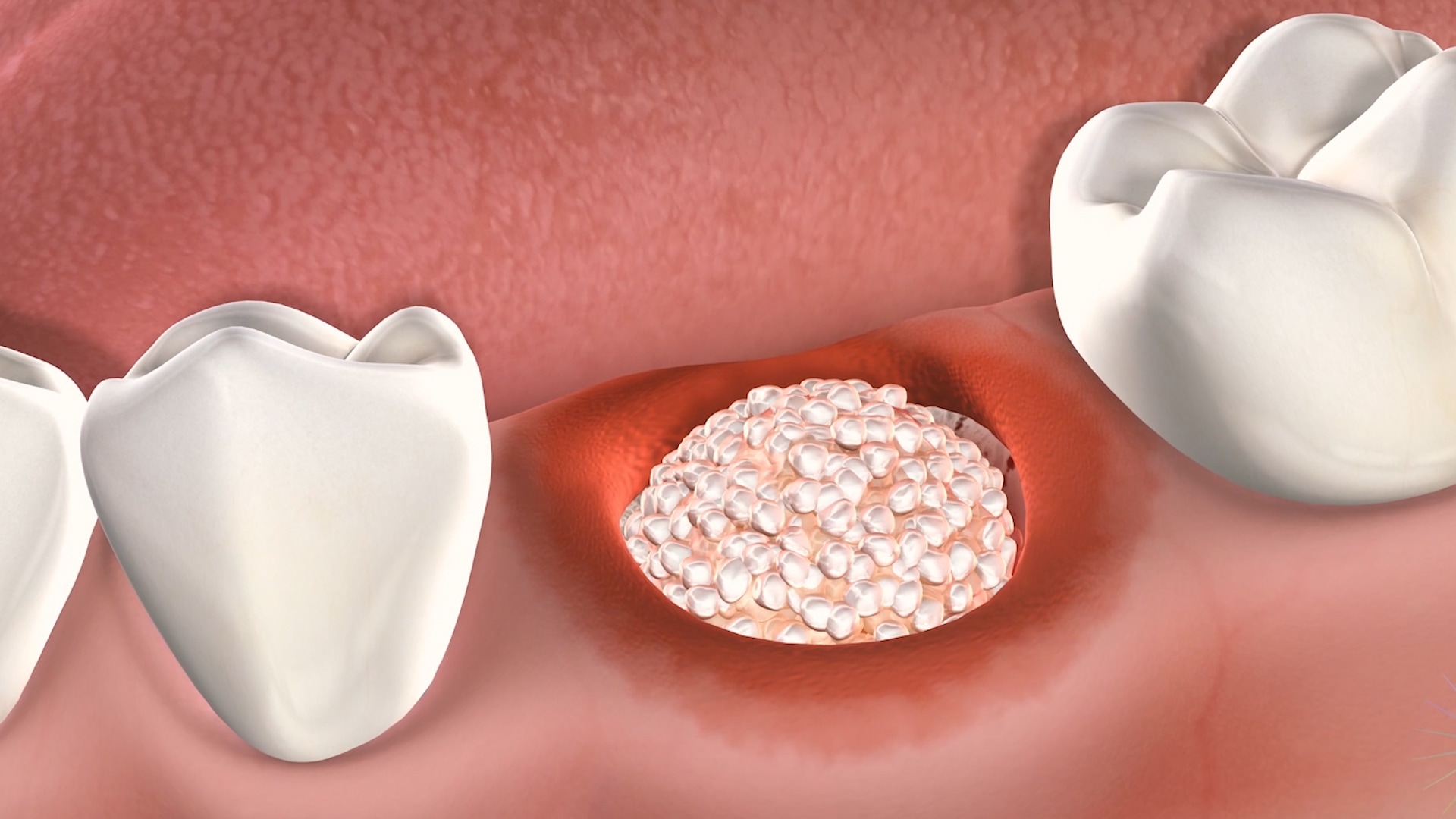 Post Operative Instructions Following Sinus Grafting Surgery At Oral Surgery Specialists Of Oklahoma