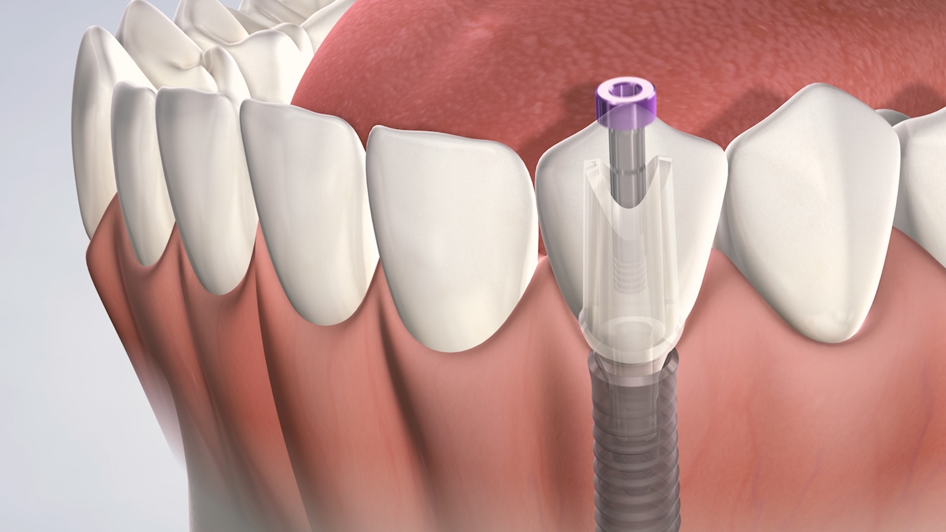 Postoperative instructions following dental implant surgery at Oral