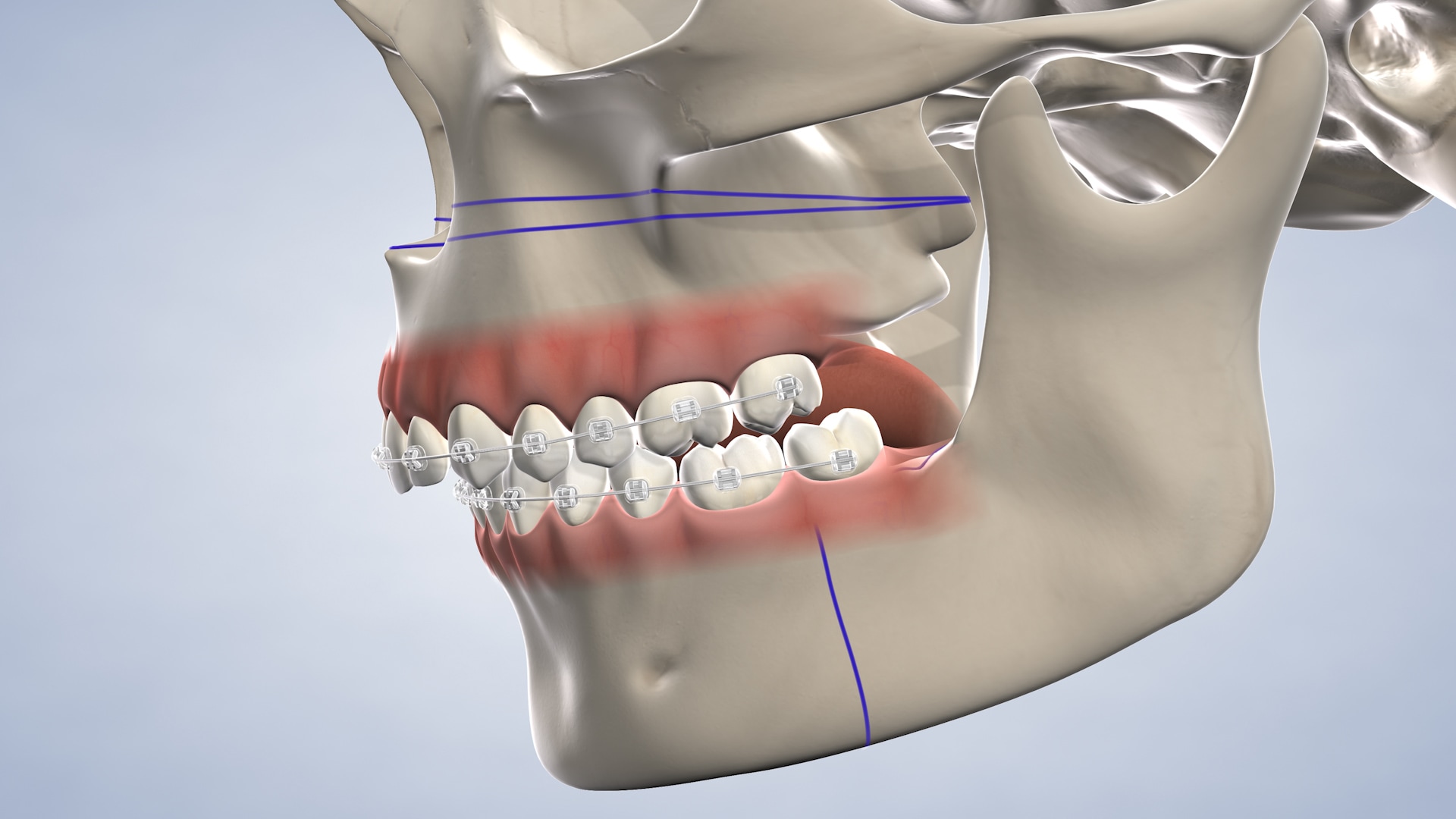 Post Operative Instructions Following Orthognathic Jaw Surgery