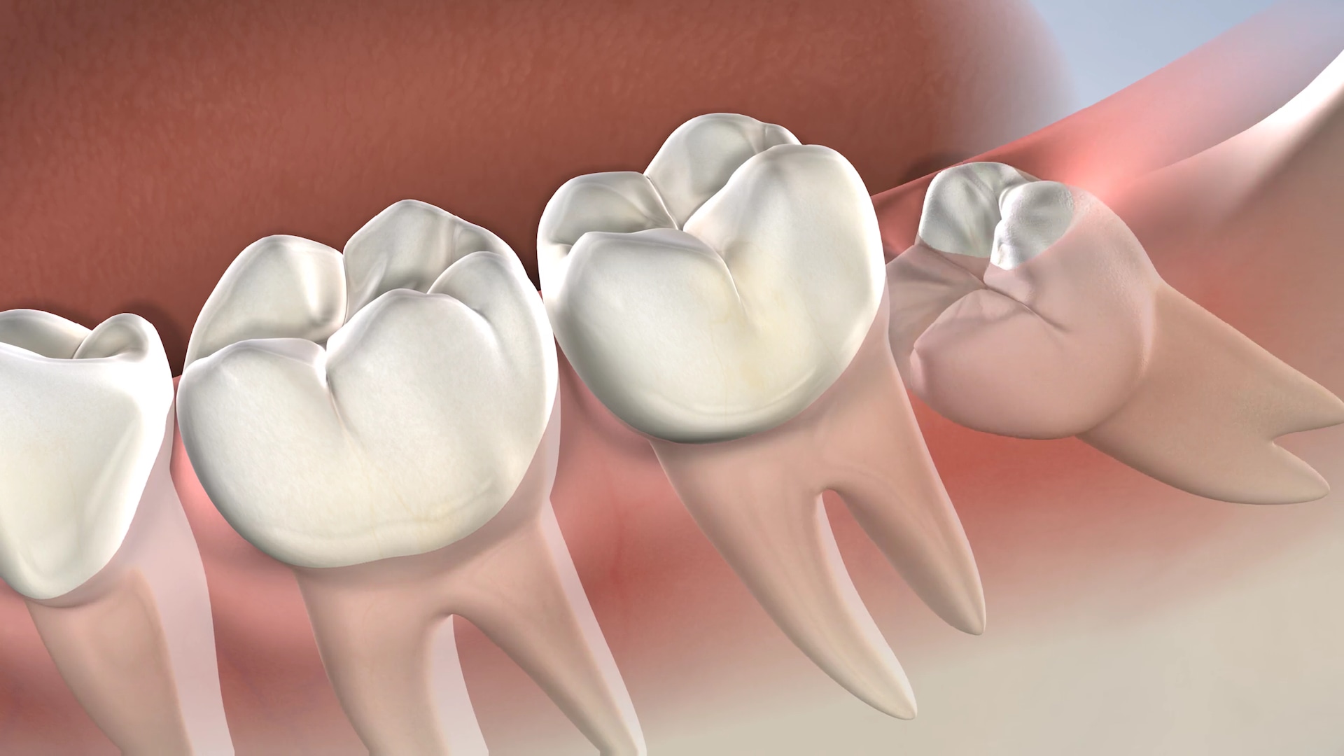 Post Operative Instructions Following Wisdom Tooth Extractions At Oral Surgery Specialists Of Oklahoma