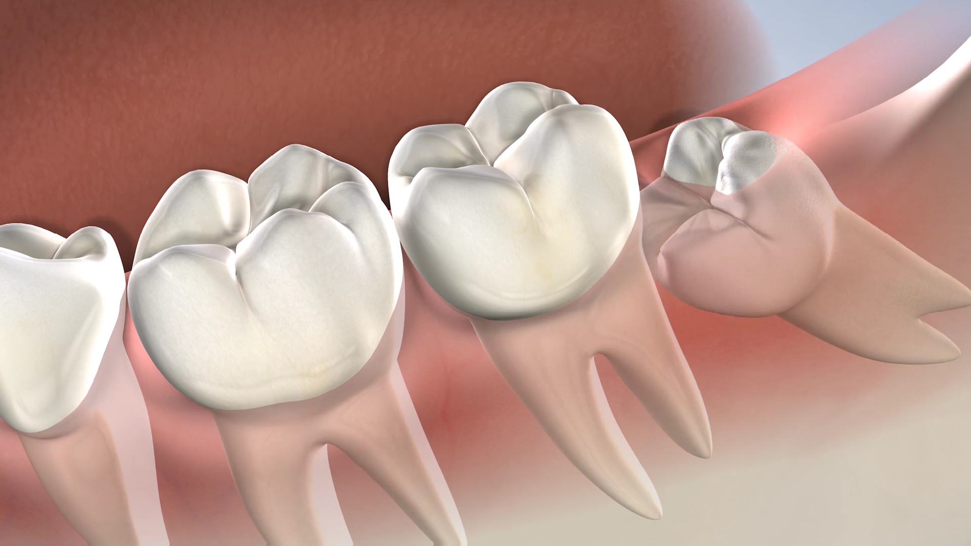 Post-operative instructions following wisdom tooth extractions at Oral  Surgery Specialists of Oklahoma