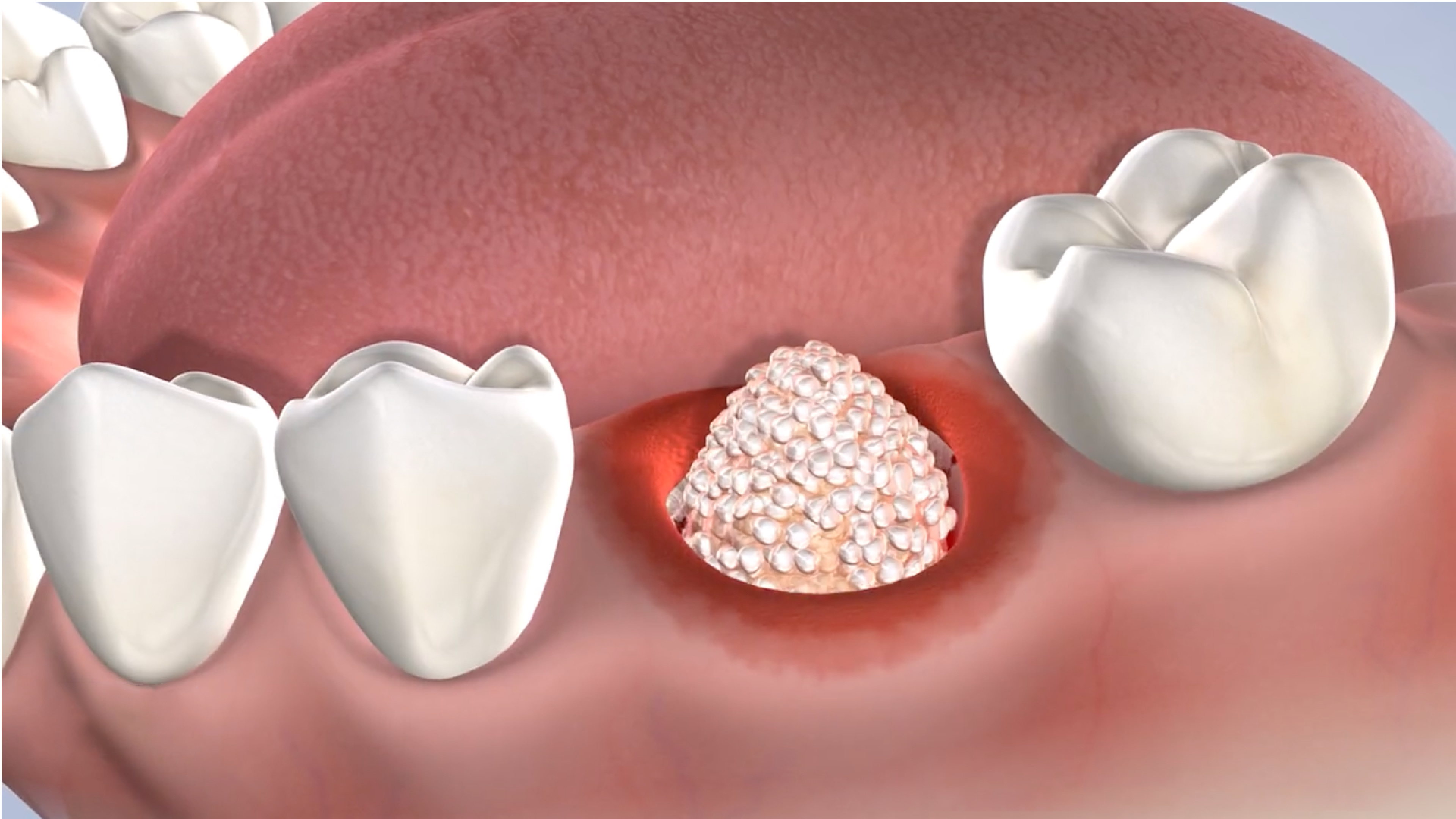 Bone graft post-operative instructions