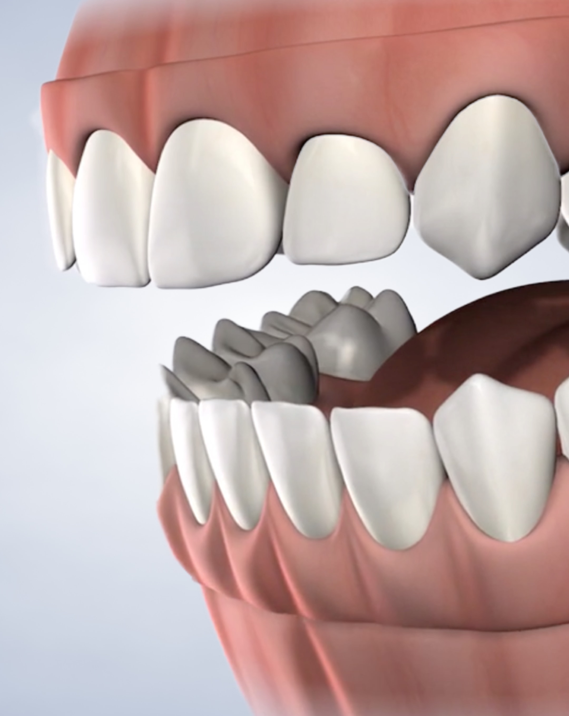 Dentures in San Francisco, CA