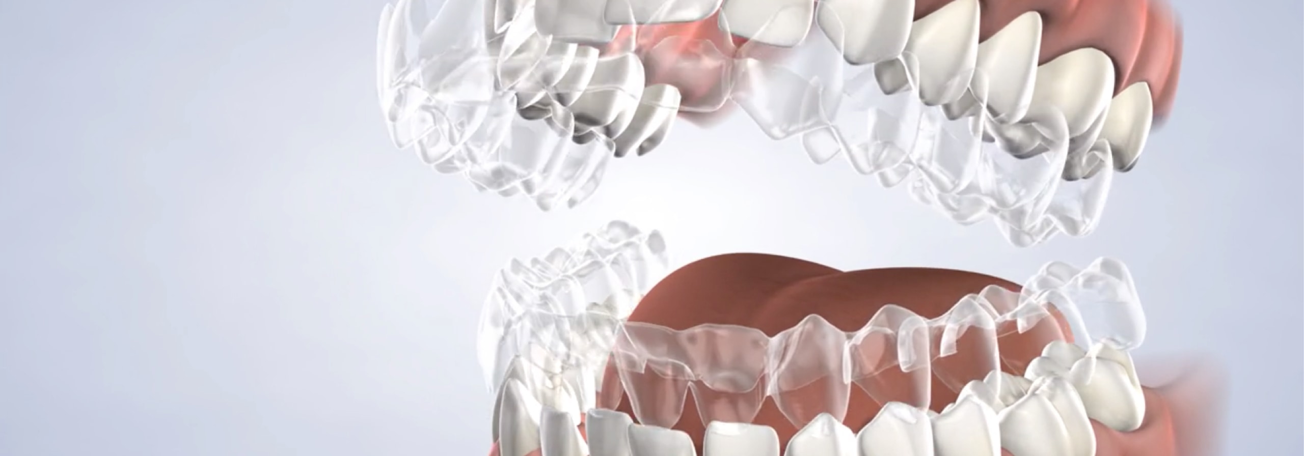 Invisalign in San Francisco, CA