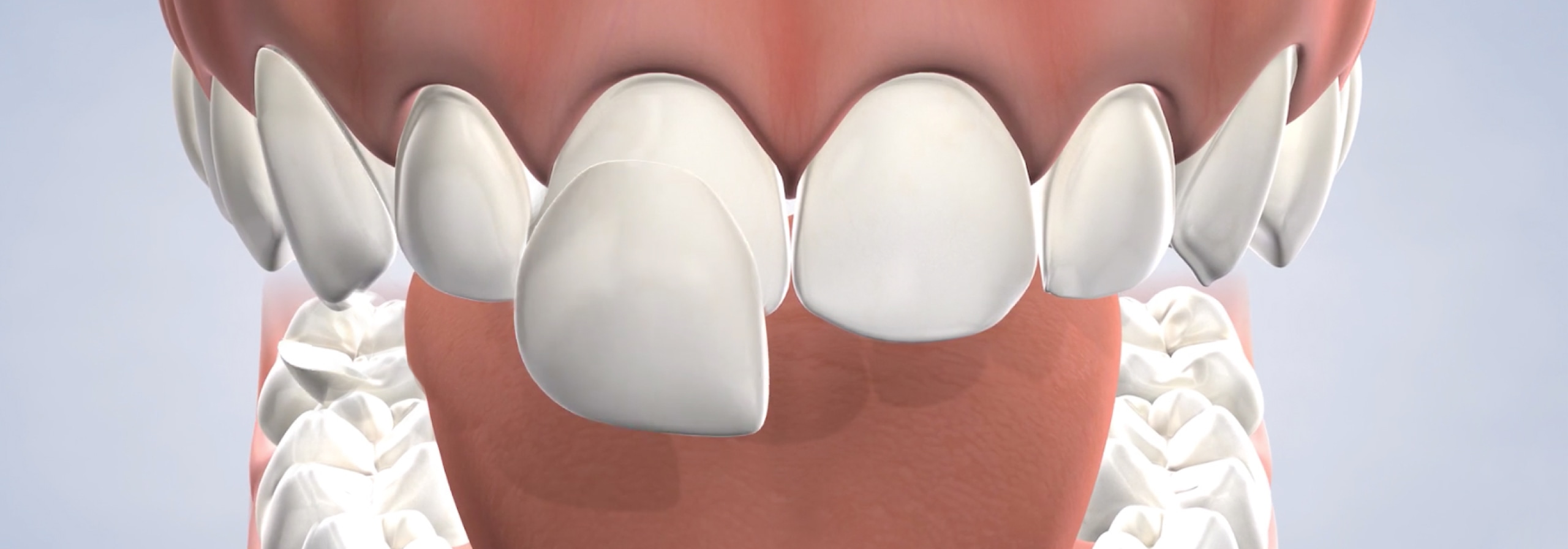 Veneers in San Francisco, CA