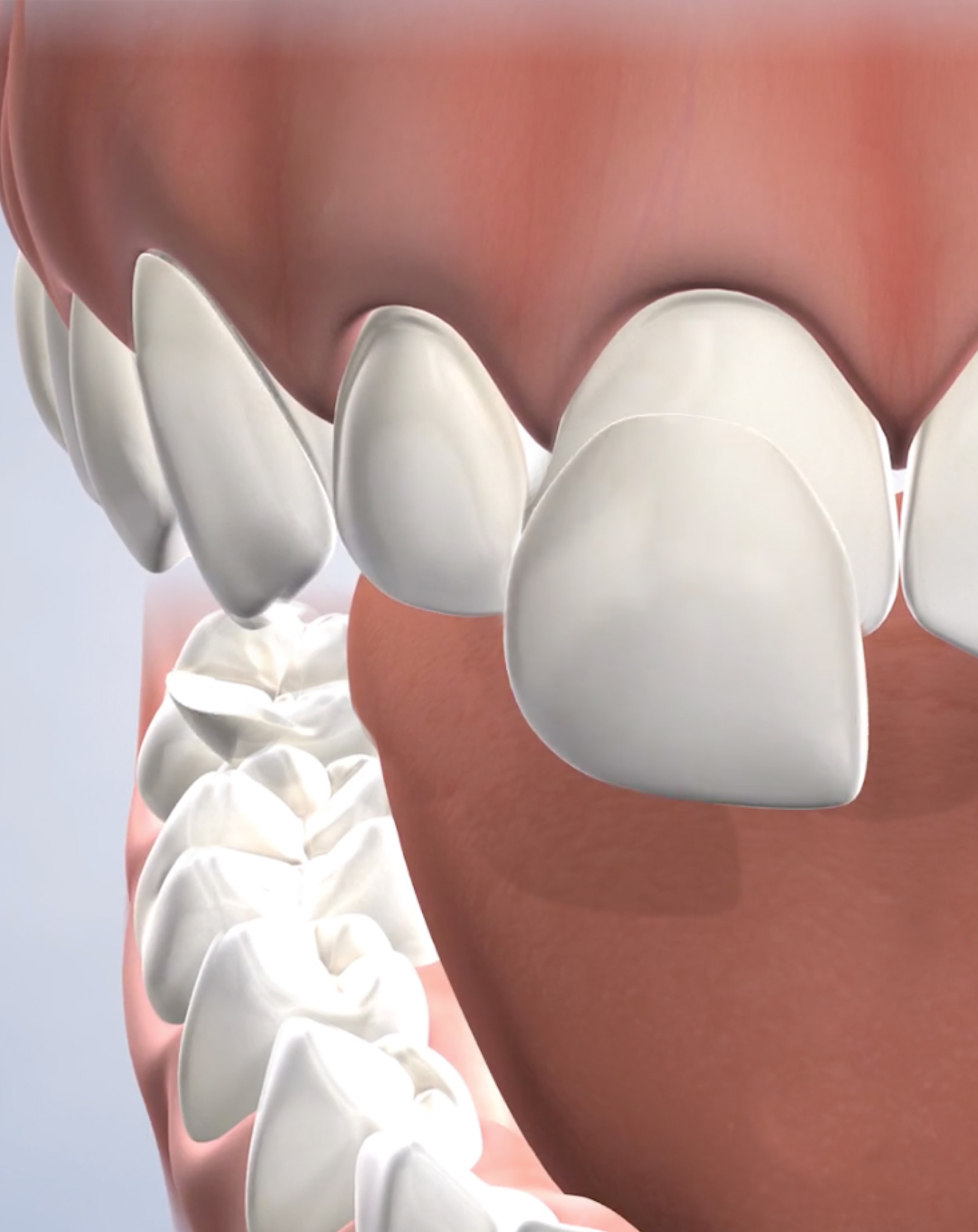 Porcelain Veneers in San Francisco, CA Dentist in San Francisco