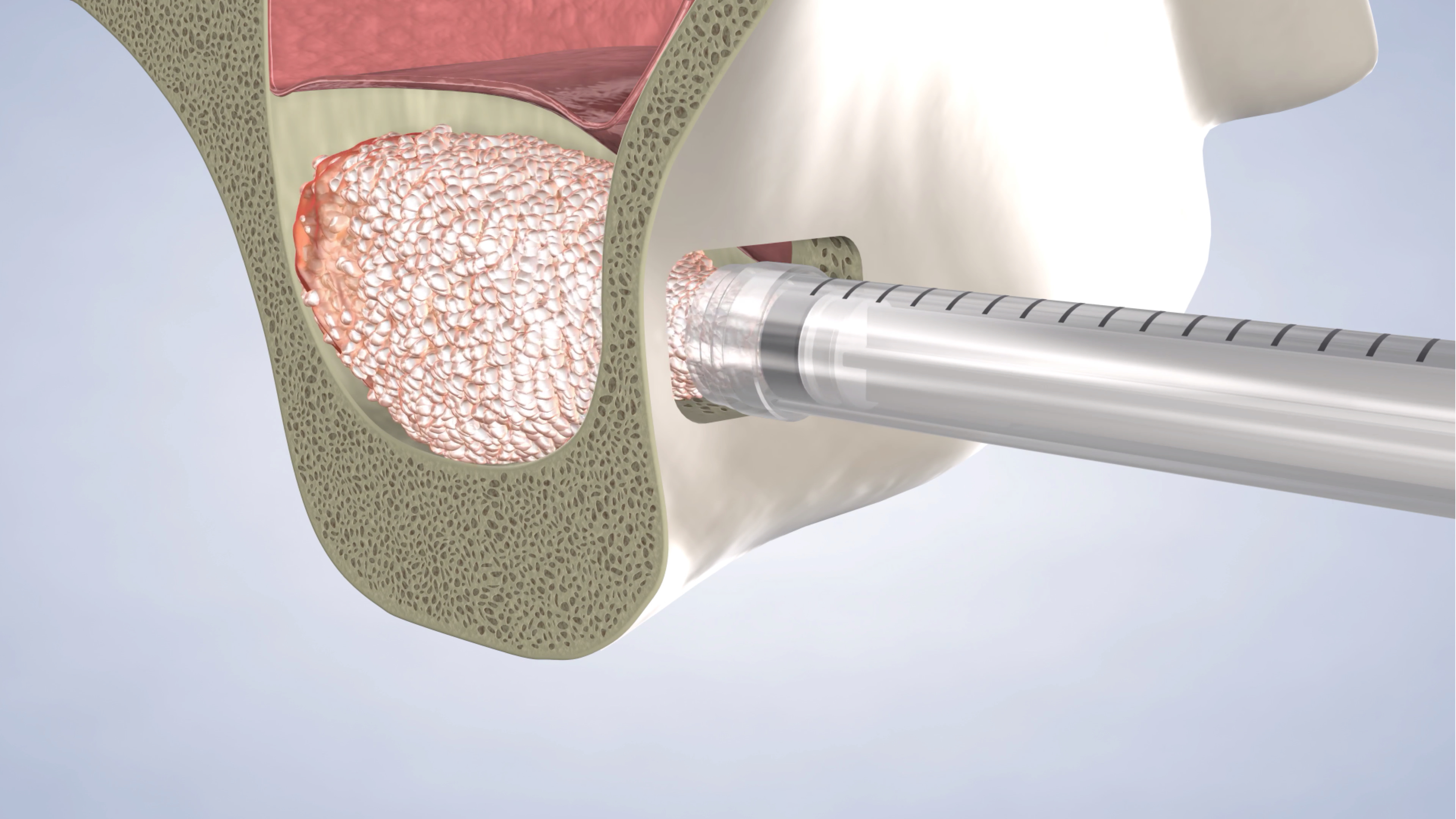 Sinus lift, post-operative instructions in South Jordan, Provo, Payson, and Lehi, Utah