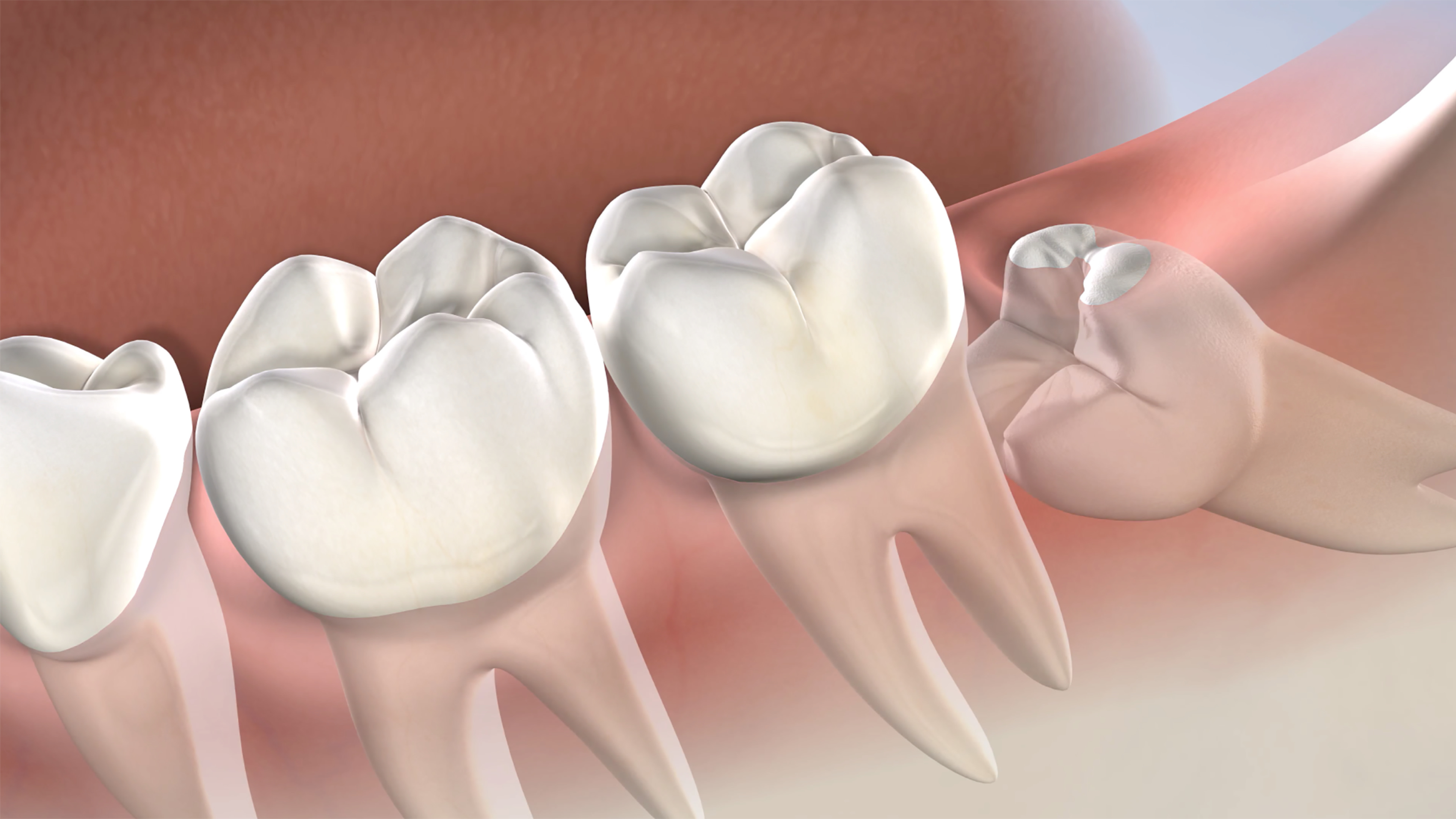 Wisdom teeth removal, post-operative instructions in South Jordan, Provo, Payson, and Lehi, Utah