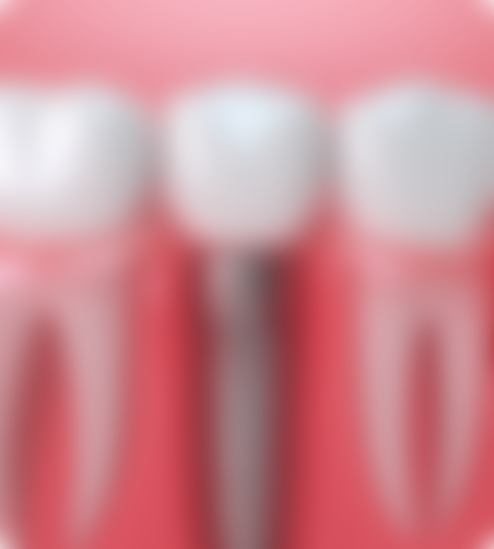 Blog detal implant marketing mobile