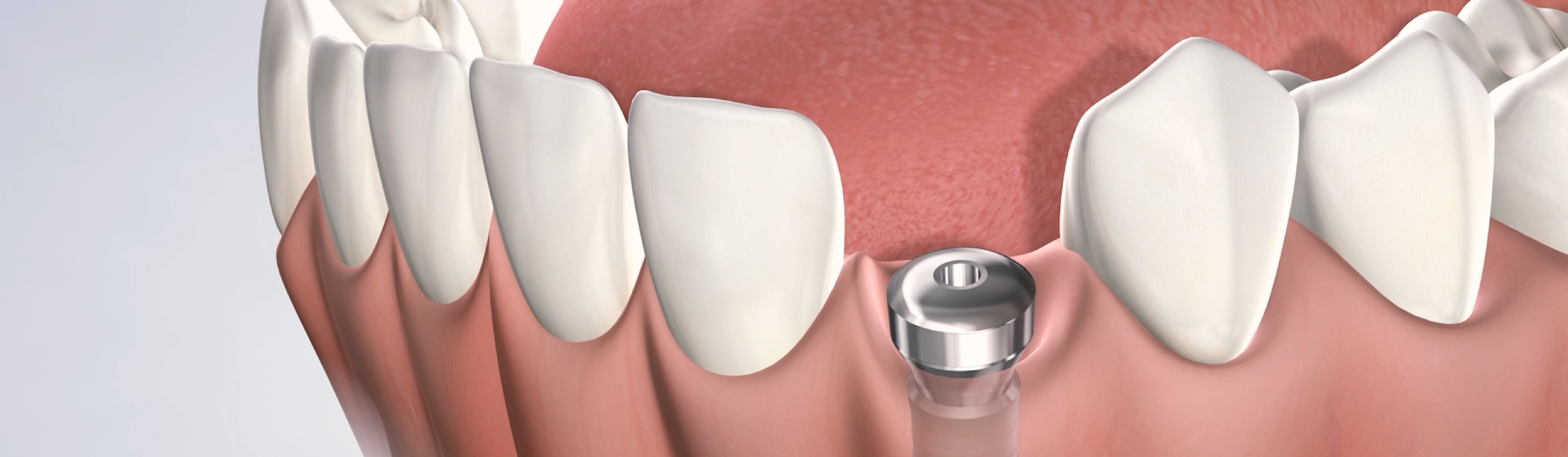 dental implant