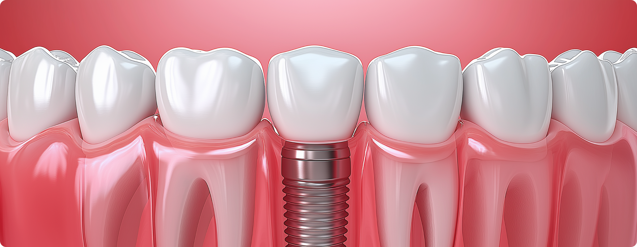 Blog detal implant marketing
