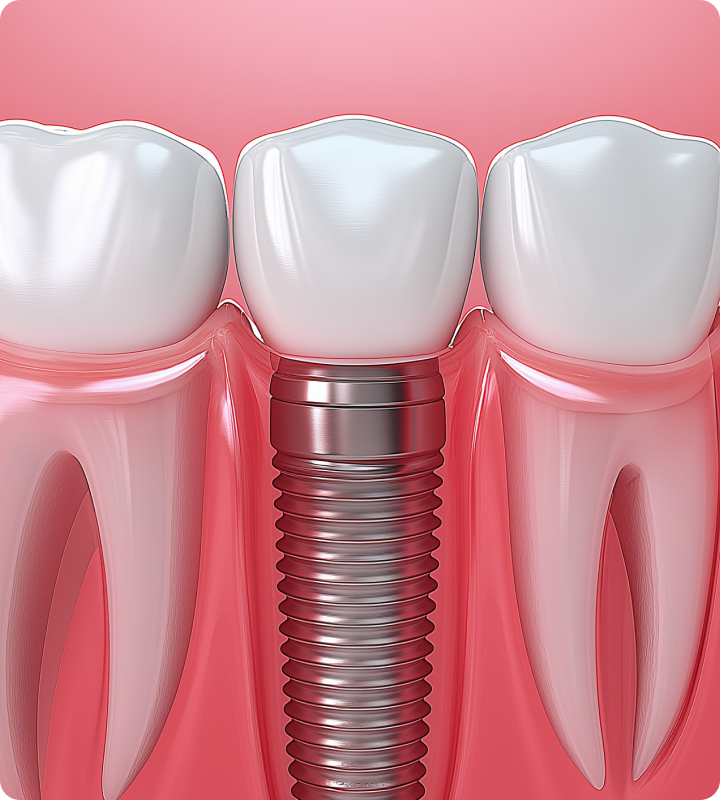 Blog detal implant marketing mobile