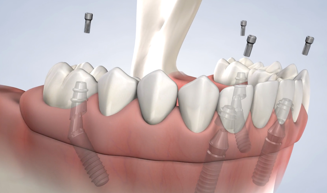 full arch restoration