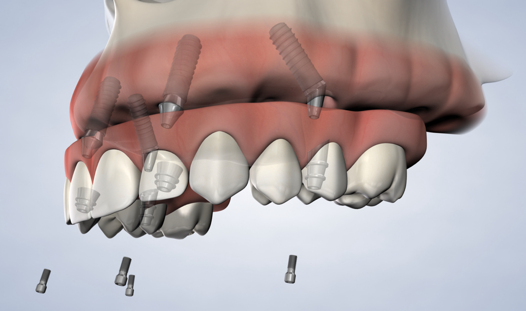 full-arch restoration