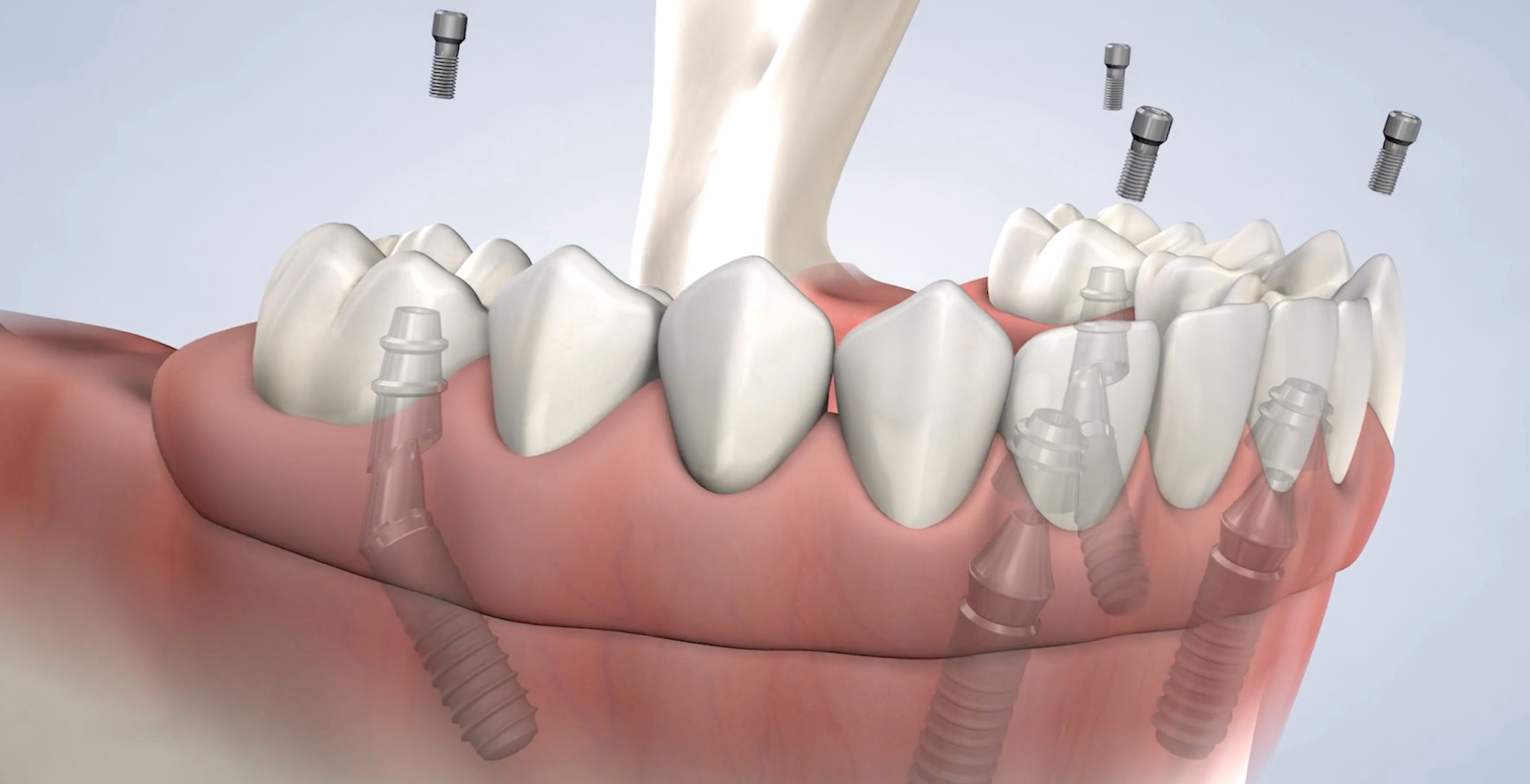 full arch restoration