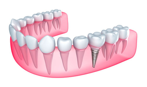 A diagram of how a dental implant works.