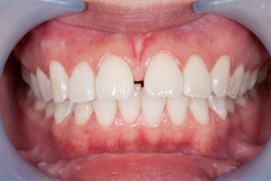 Close-up of healthy teeth and gums of a patient at Madison Oral Surgery & Dental Implants