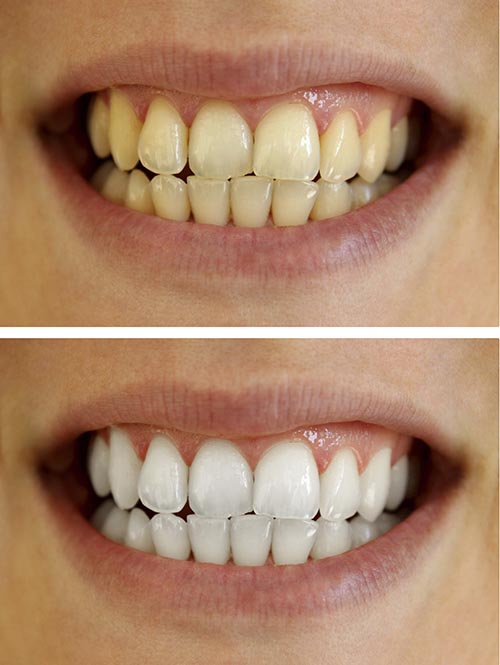 A patients smile before and after a whitening treatment.