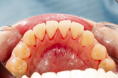 A patients teeth suffering from gum disease; and is in need of a gum graft. A patients teeth suffering from gum disease; and is in need of a gum graft.