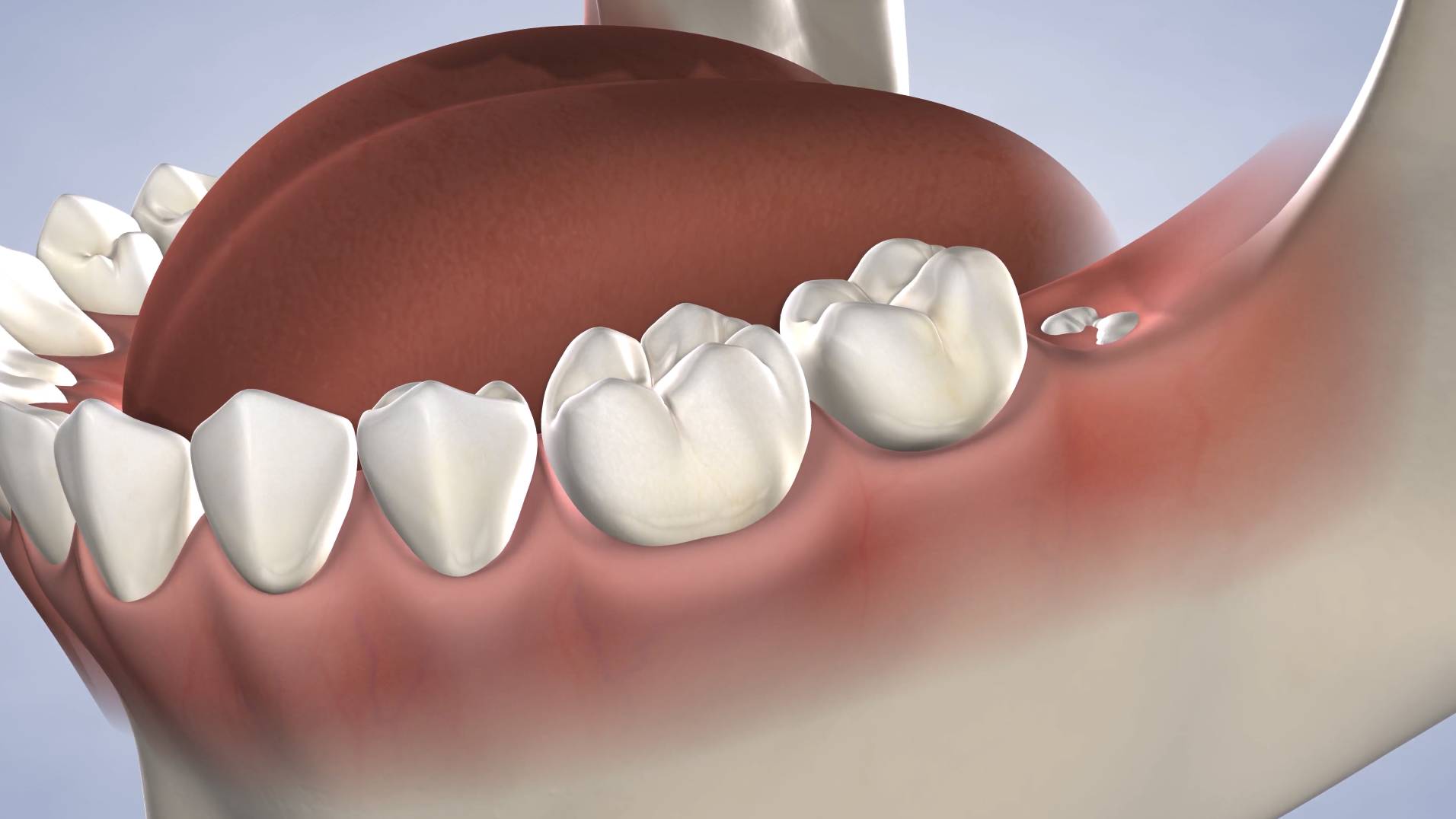 Procedure Wisdom Teeth2 