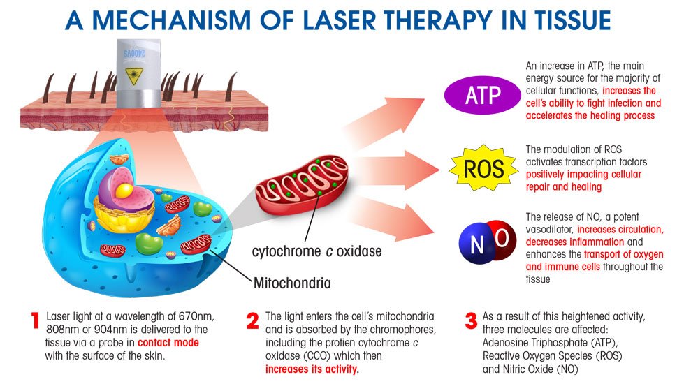 class iv laser therapy is a cutting-edge, non-invasive device that utilizes high-powered laser to penetrate deep into tissues, promoting cellular regeneration, reducing inflammation, and providing rapid, effective pain relief, laser diagram