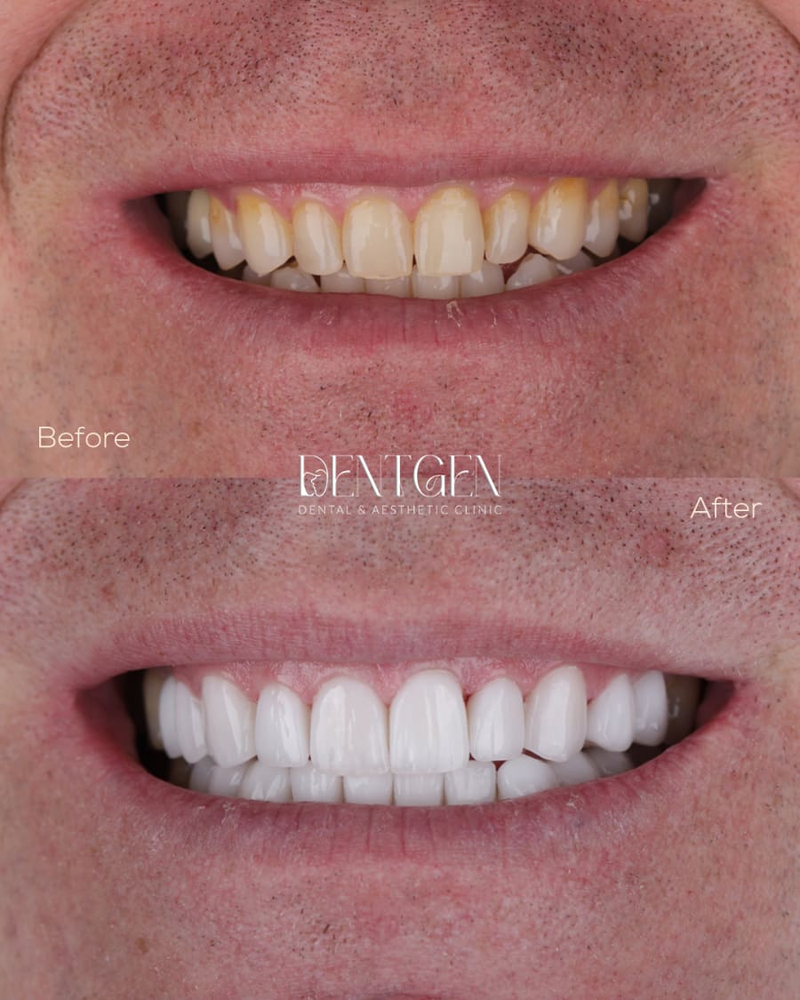 Veneers Dubai before and after 6