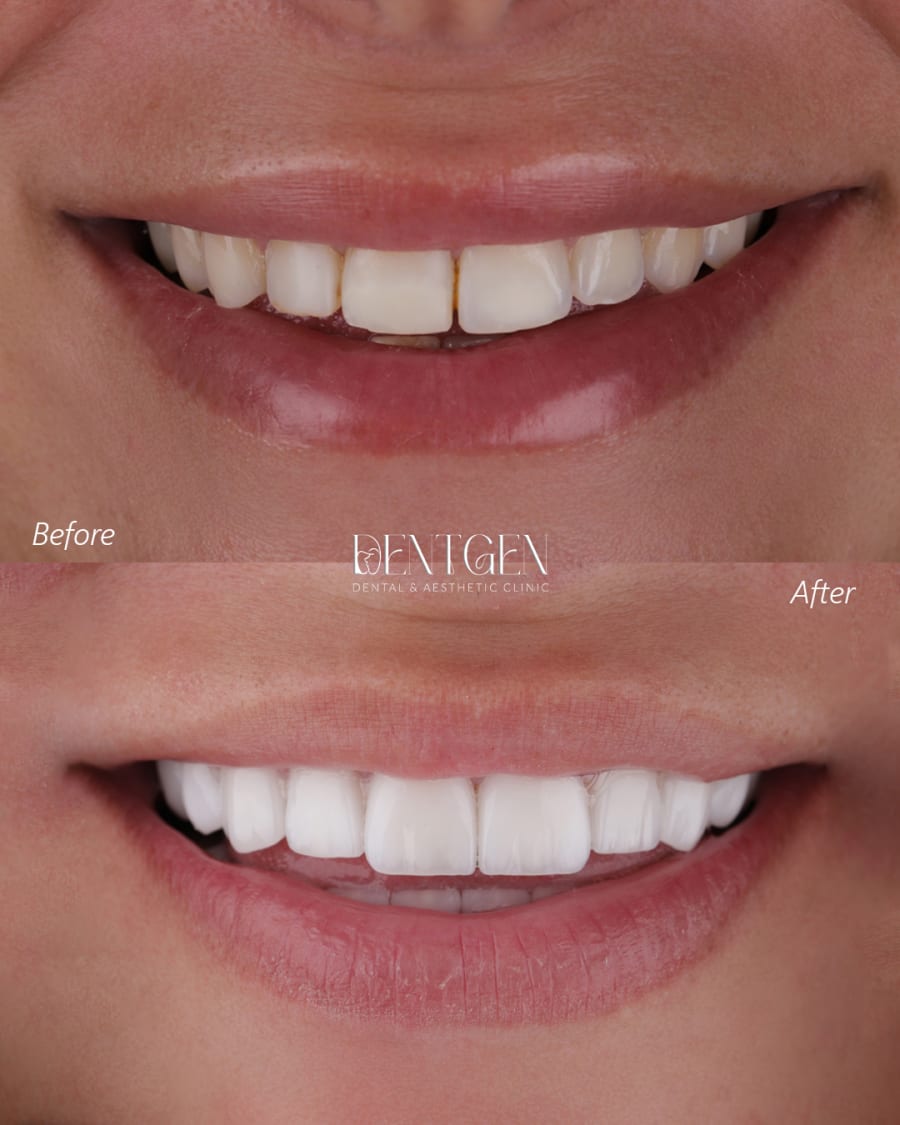 Veneers Dubai before and after 5