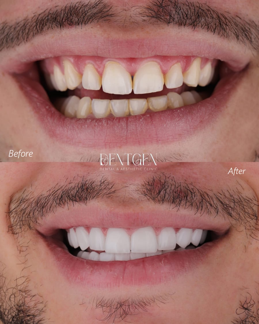 Veneers Dubai before and after 4