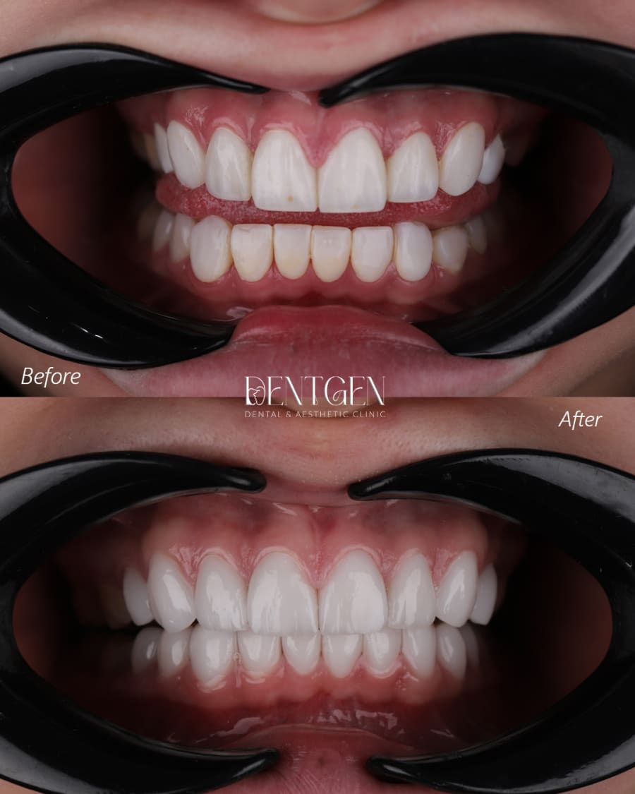Veneers Dubai before and after 3