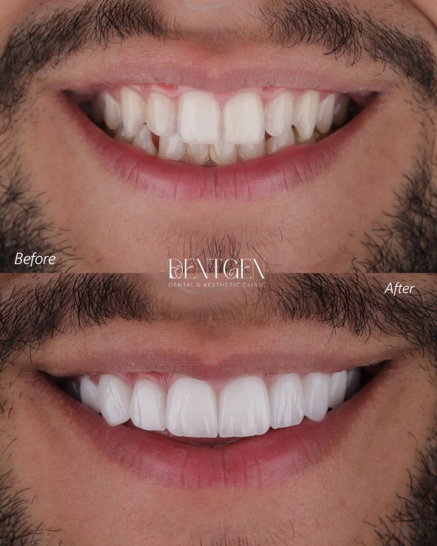 Veneers Dubai before and after 2