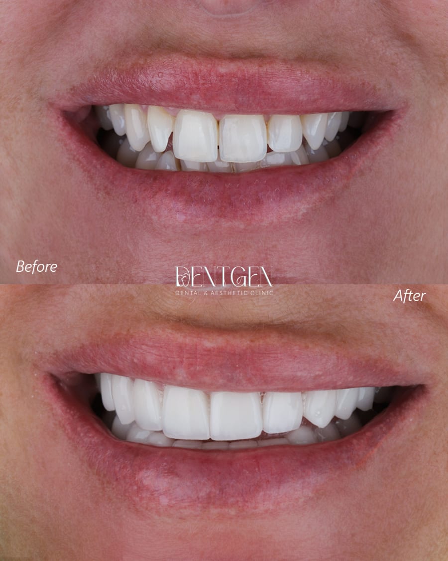 Veneers Dubai before and after 1