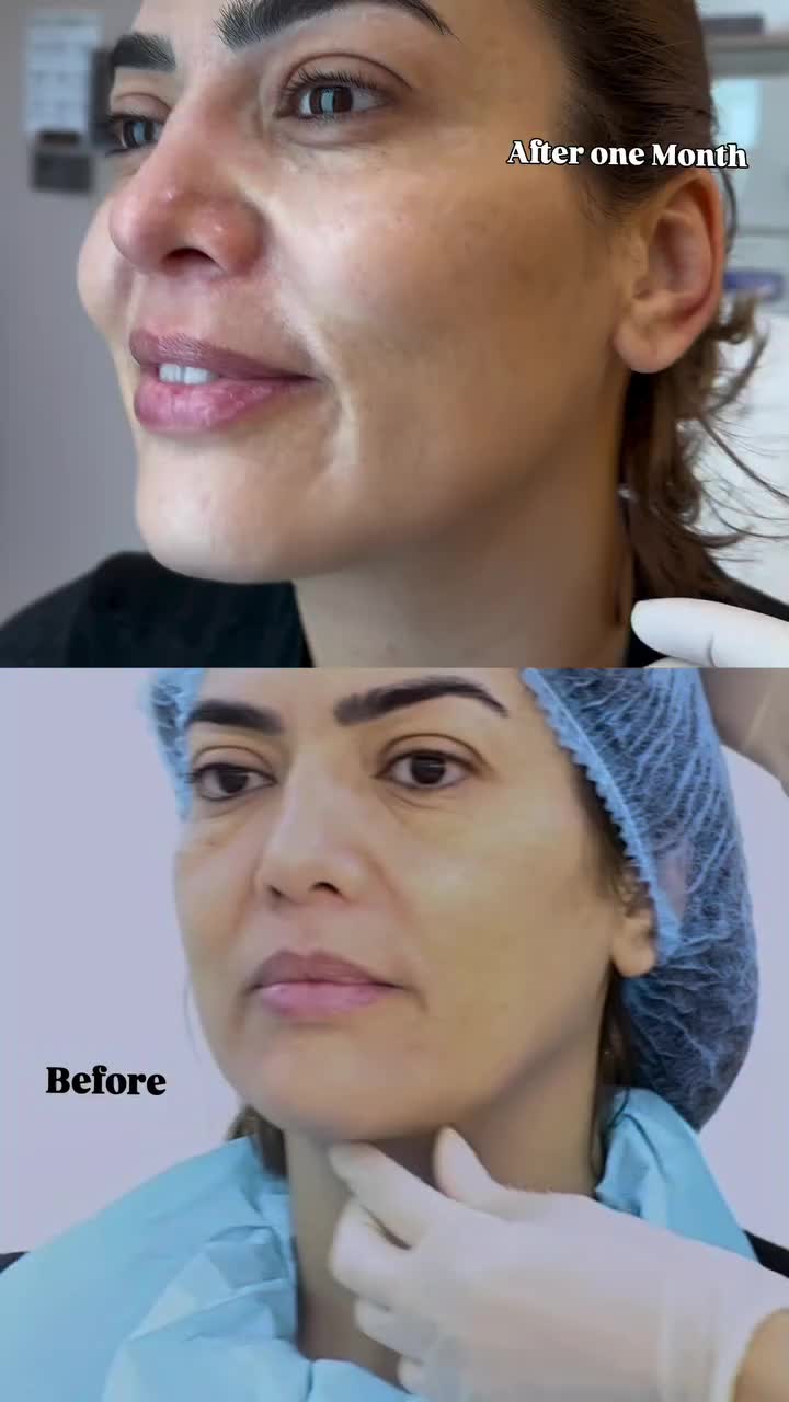 Endolift treatment