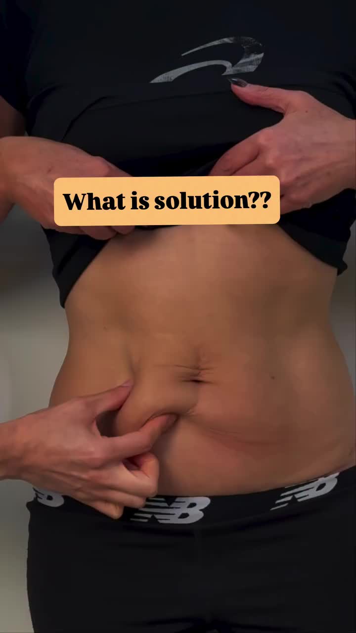 Endolift ten week result
