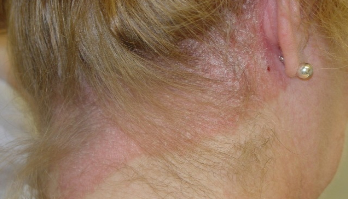 Artikkelbilde - Psoriasis