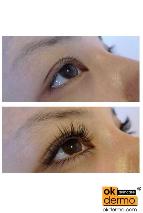 latisse eyelash serum