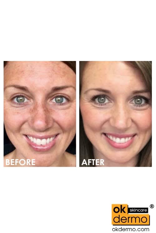 3% Hydroquinone USP HQ Cream Hyde® 30g | OKDERMO®