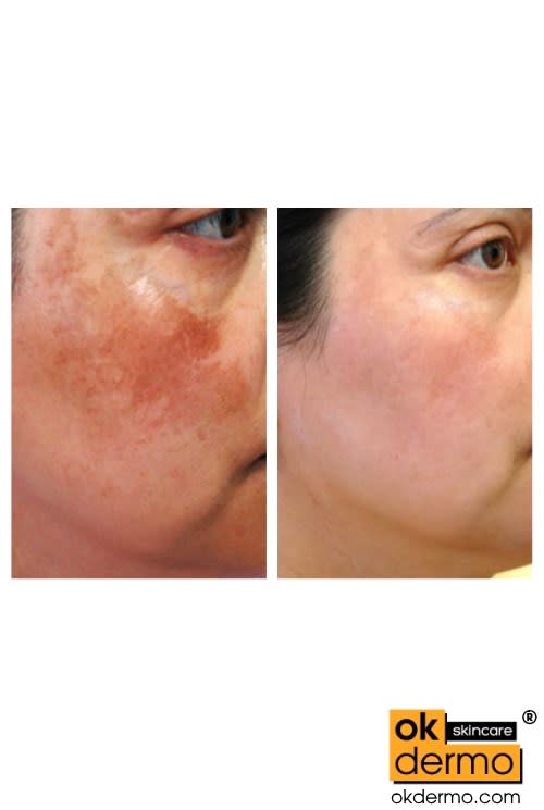 Nolvadex before and after Nolvadex before and after
