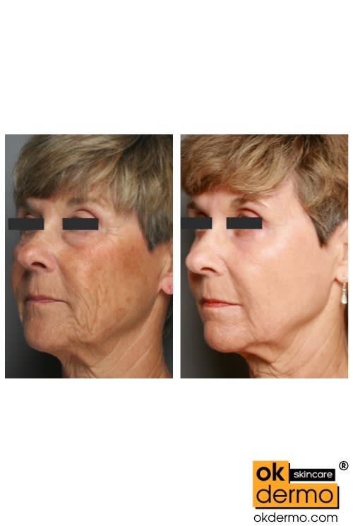 or after before oil tretinoin face 0.05 (Pure A® / Retinol Tretinoin Cream 0.025 Retin or after before oil tretinoin face 0.05 (Pure A® / Retinol Tretinoin Cream 0.025 Retin
