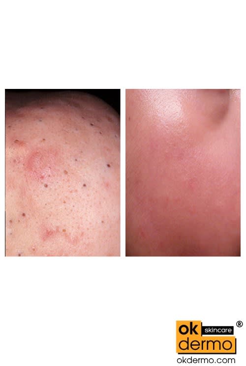 Salicylic Acid 617 + Urea 10 Ointments Salicure®/Salicylix® 20g50g