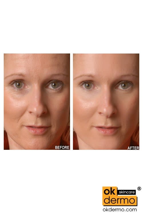 Vitamin C Serum For Face Before And After 1182