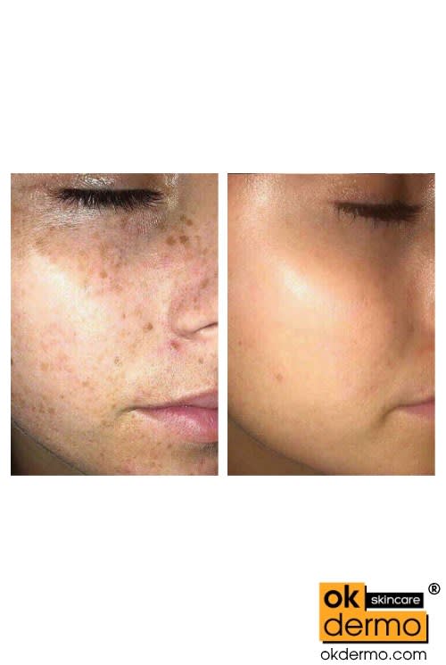 Tri Luma Cream Hydroquinone 4 Tretinoin 0 05 Fluocinolone 0 01 Tri Luma Cream Hydroquinone 4 Tretinoin 0 05 Fluocinolone 0 01
