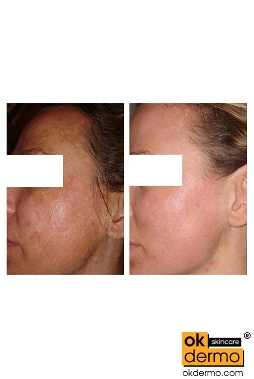 SkinLite® Hydroquinone 2 + Tretinoin 0.025 + Mometasone 0.1 Cream