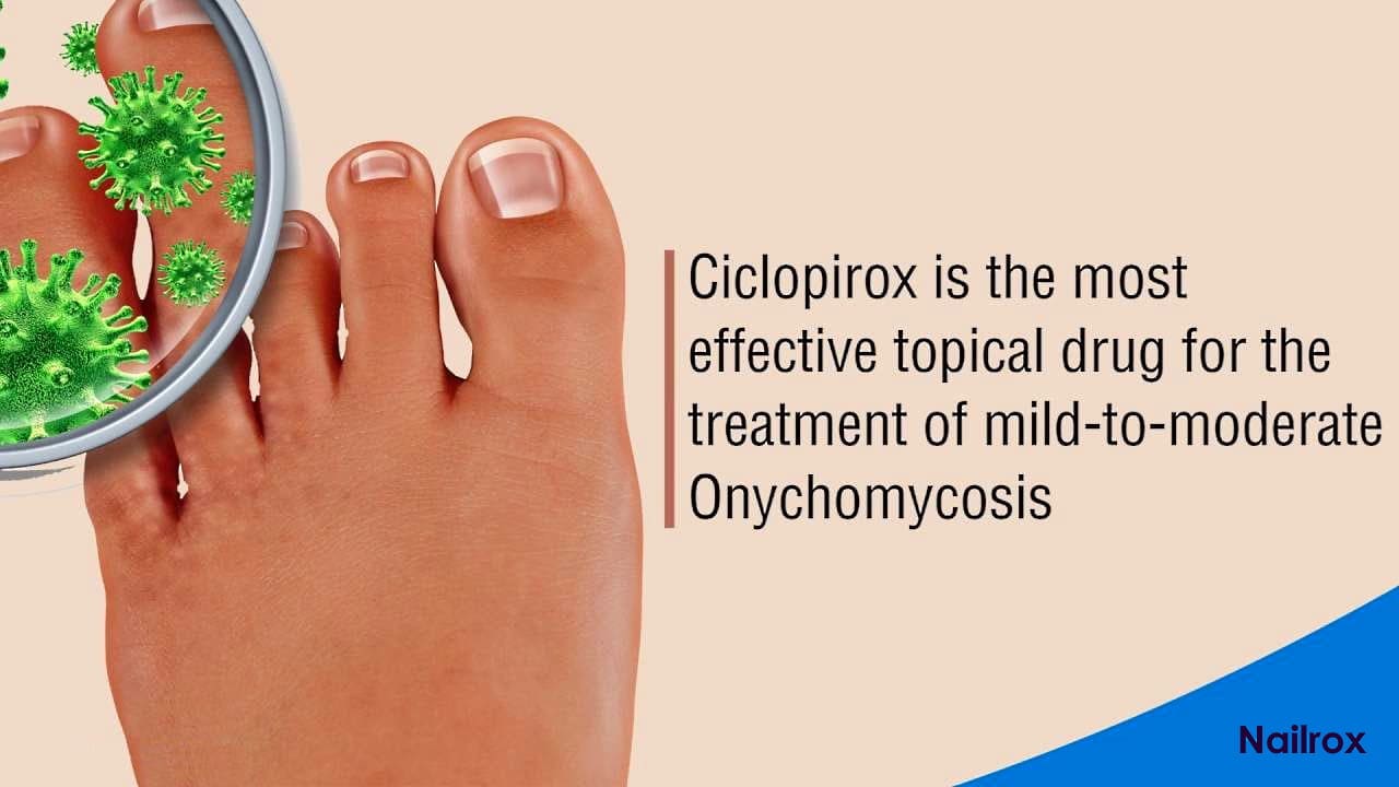 [Ciclopirox Olamine 8] Topical Solution Nail Lacquer Nailrox® 5ml